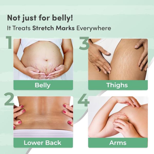 Mylo Care Stretch Marks Combo (Stretch Mark Oil - 100 ml, Stretch Marks Cream - 100 ml) |Stretch Marks removal for women